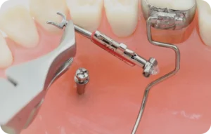 Dentiste Paris 15, Dr Perez : chirurgie orthodontique