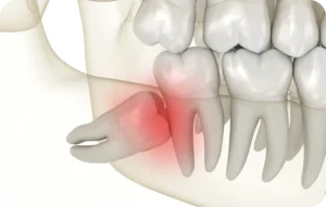 Dentiste Paris 15, Dr Perez : Faut-il retirer toutes les dents de sagesse ?