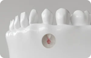 Dentiste Paris 15, Dr Perez : taitement de canal, retraitement endodontique