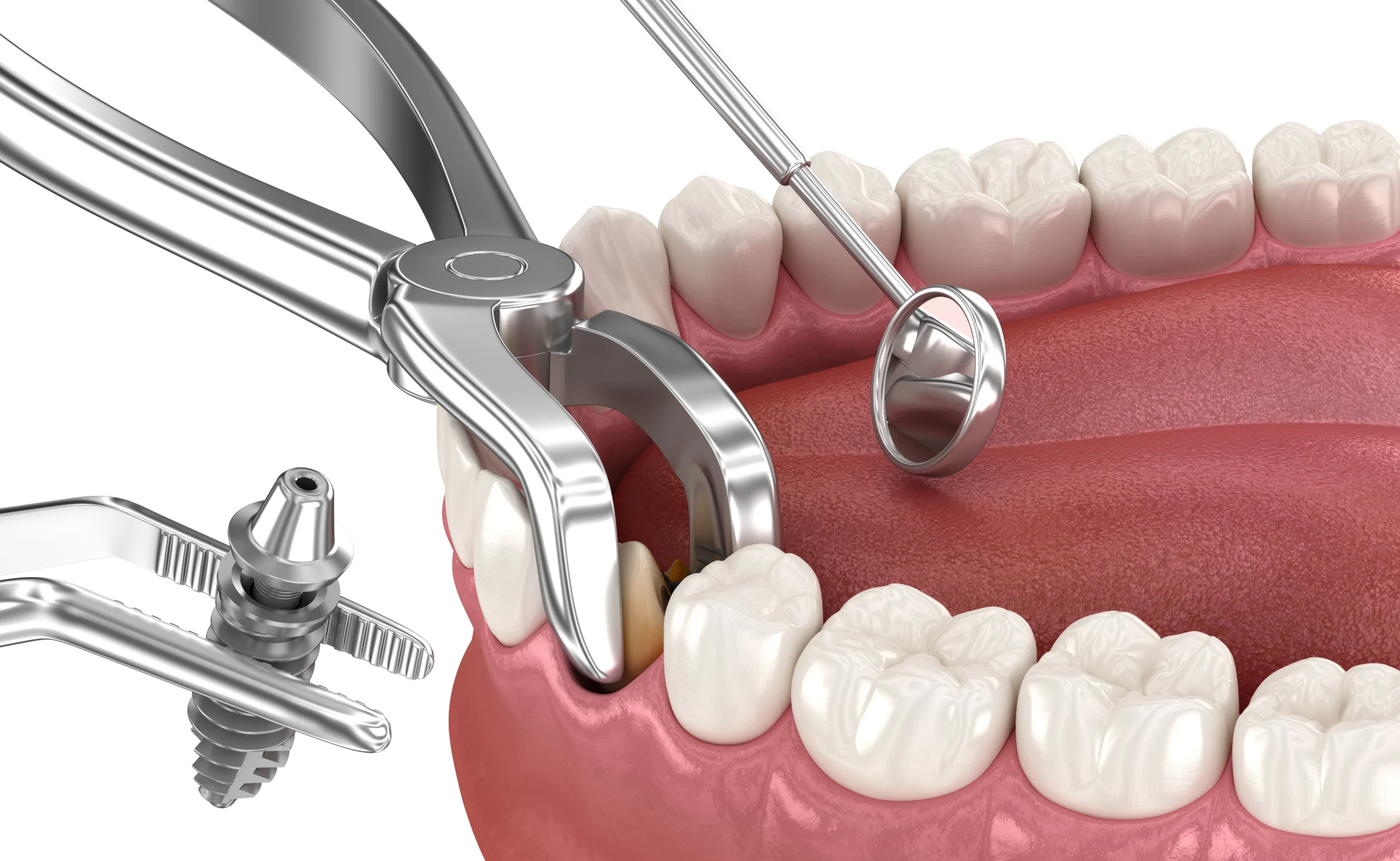   Extraction implantation immédiate