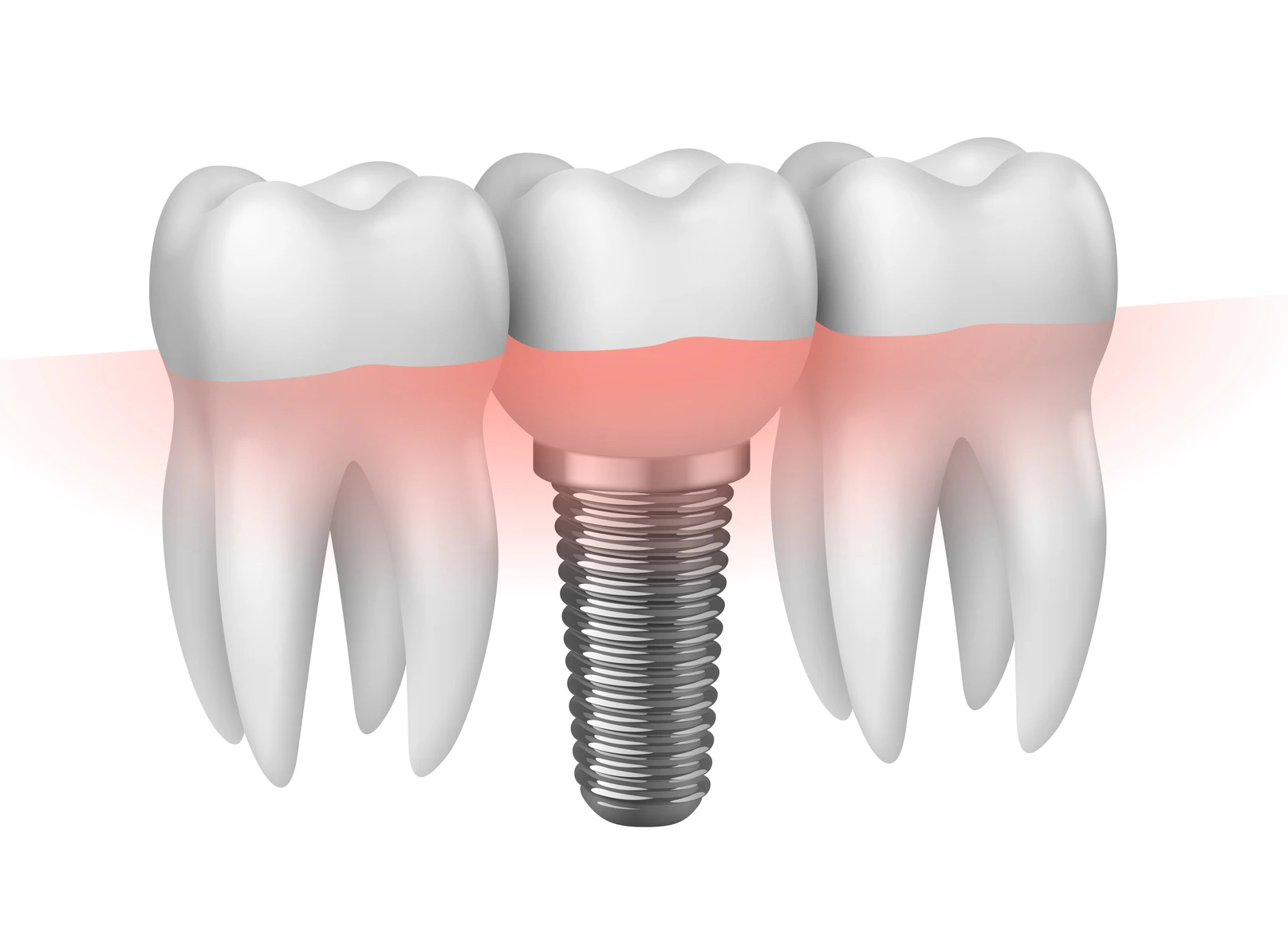   Implant unitaire