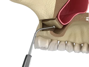 Sinus lift au Cabinet du Dr Perez, dentiste Paris 15