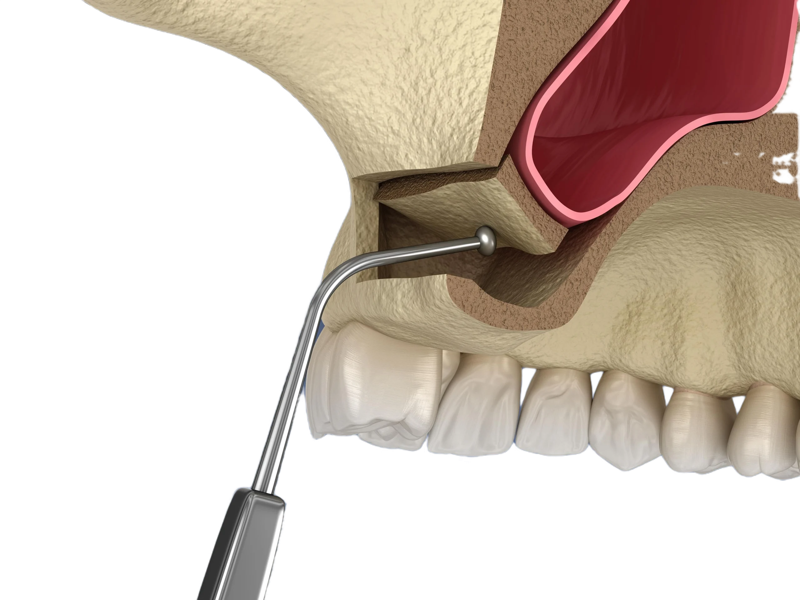   Sinus lift