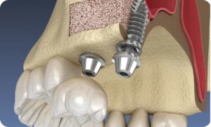 Sinus lift à Paris 15, Dr Romain Perez, chirurgien-dentiste